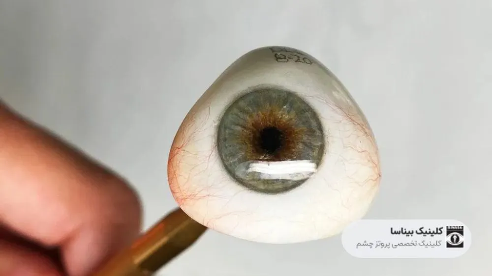 چشم مصنوعی آکروکامپوزیت