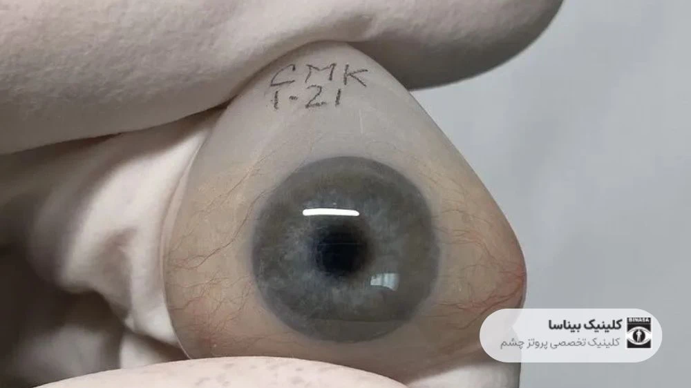 نکات مهم در استفاده از پروتز چشم