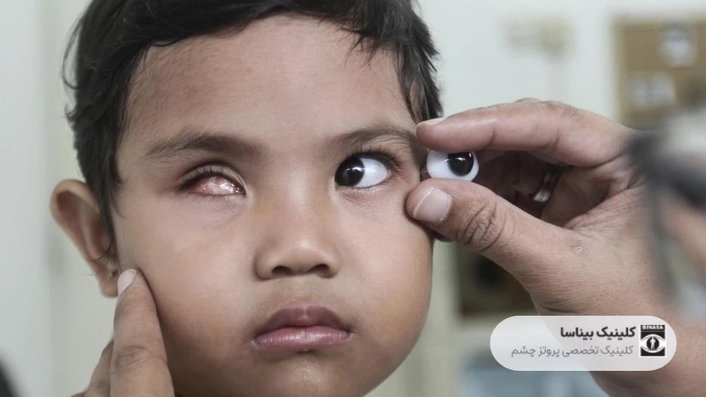 ساخت پروتز چشم برای کودکان