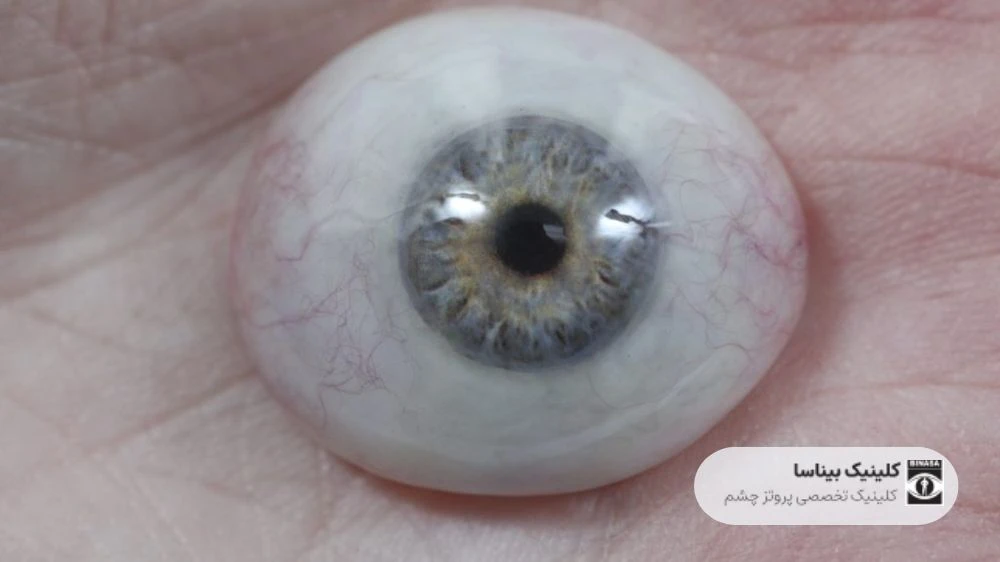 روشهای ارائه پروتز چشم