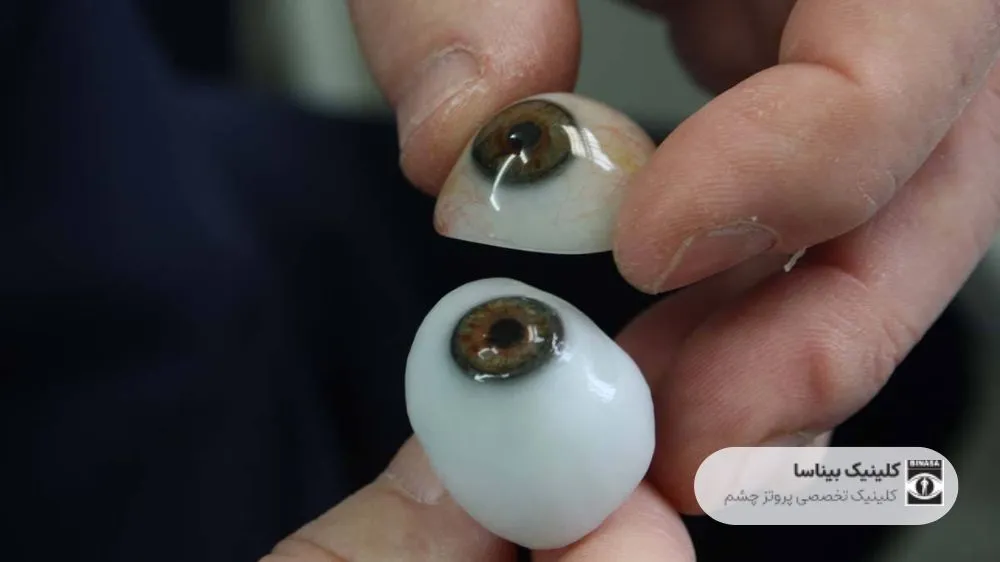 انواع روش ساخت پروتز چشم و نحوه استفاده آن
