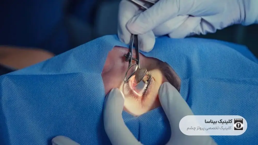 جراحی پروتز چشم