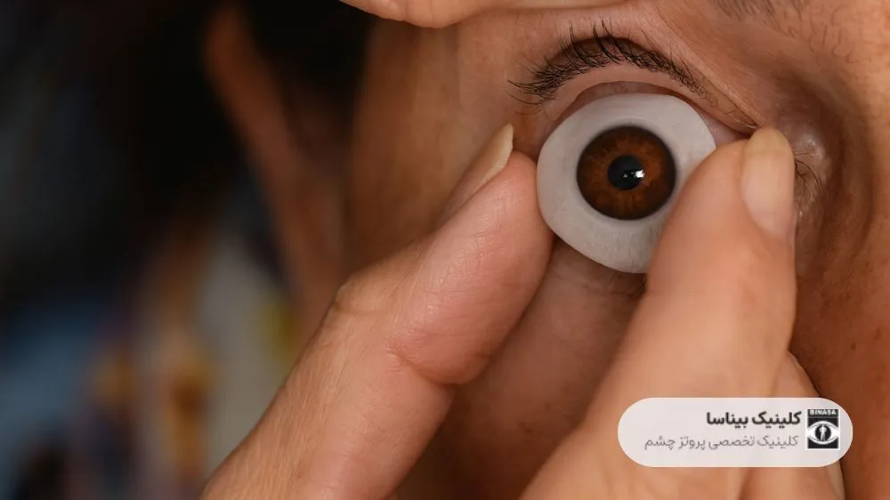پروتز چشم متحرک (چشم مصنوعی قابل حرکت)
