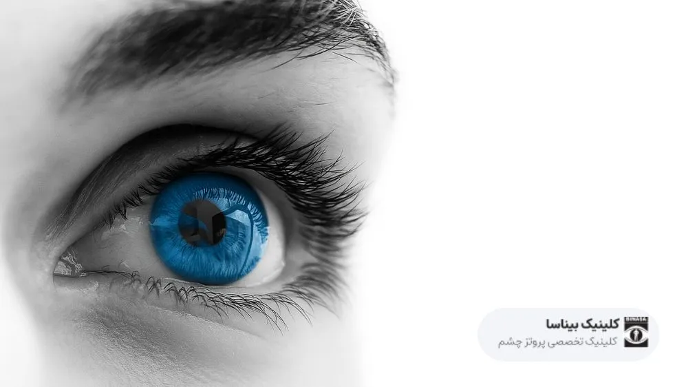 بهترین چشم مصنوعی در ایران