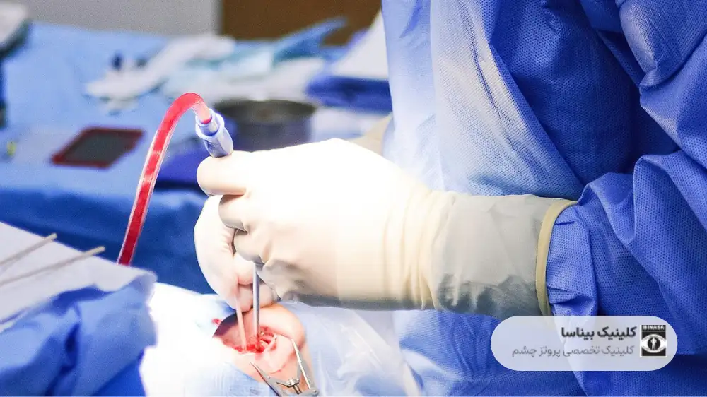 عمل تخلیه چشم