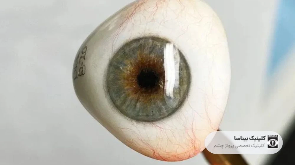 انواع ایمپلنت های چشمی