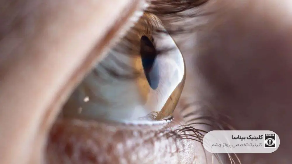 بیماری قوز قرنیه چیست؟
