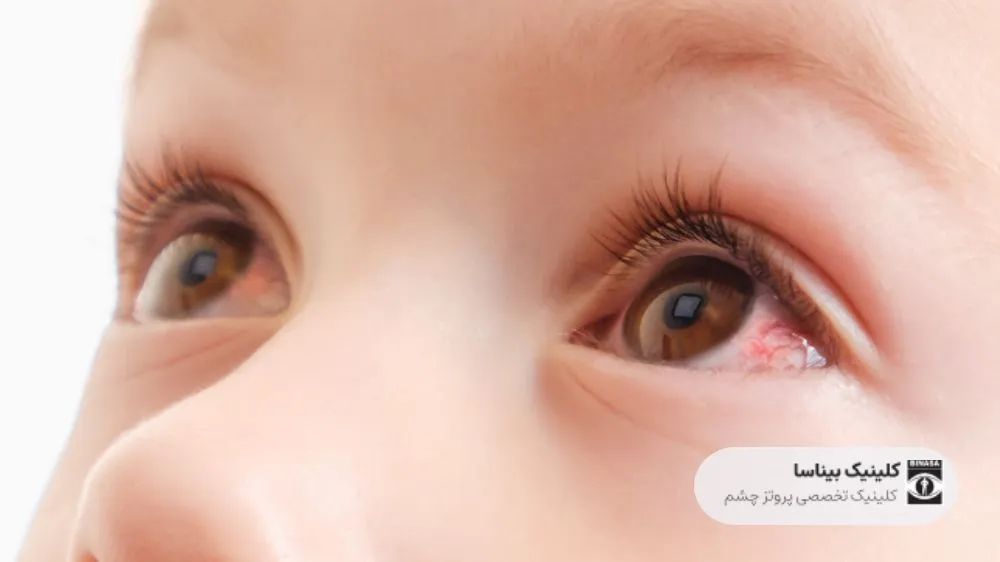 بیماری های چشم شایع در کودکان