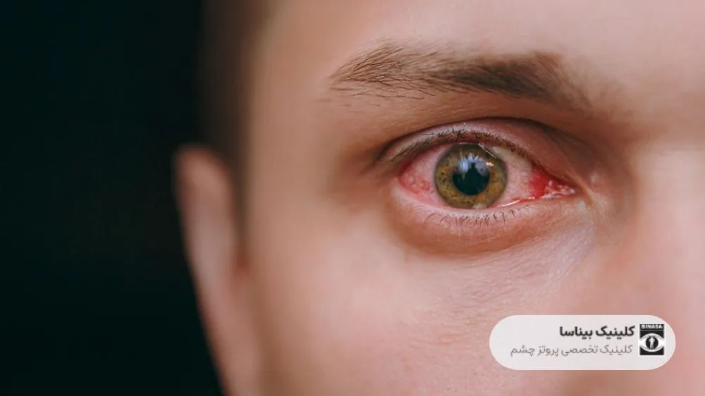 خطرناک ترین بیماری های چشم