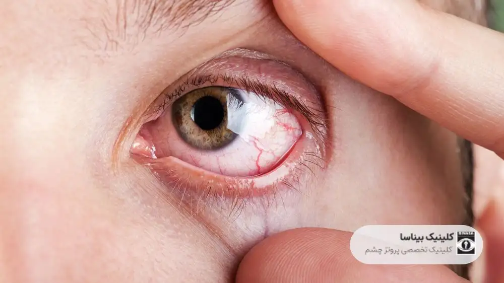 انواع بیماری های چشم