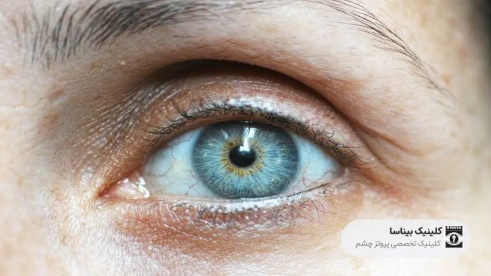 بیماری های عصب چشم