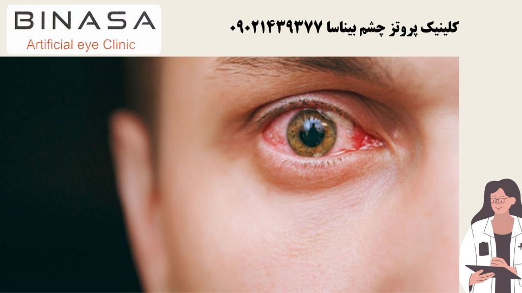 بیماری تیروئید چشم