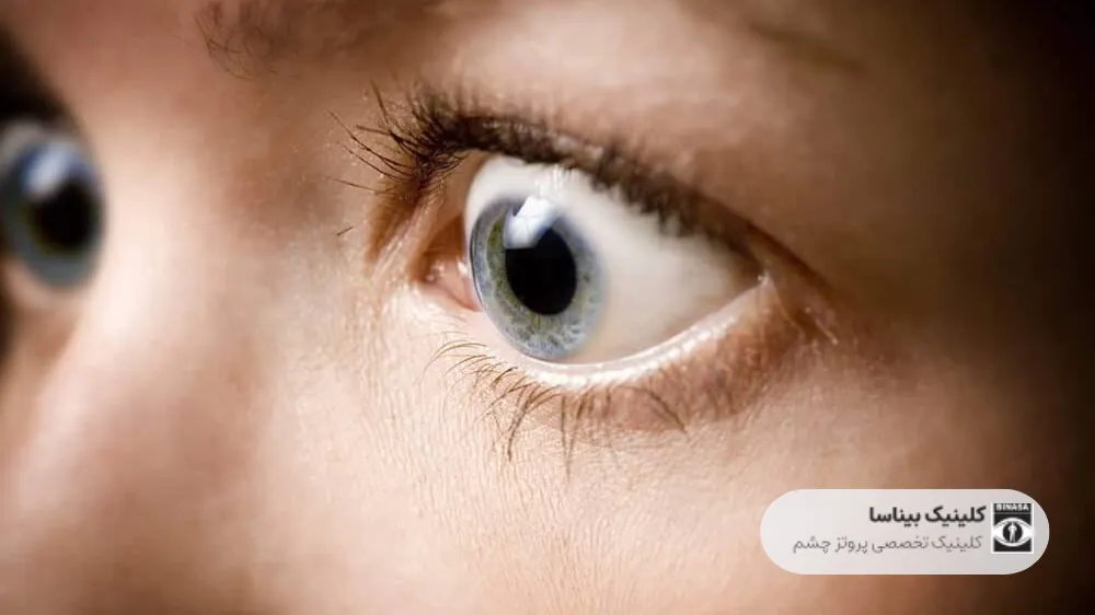 بیماری تیروئید چشم