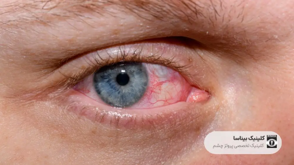 خشکی چشم چیست؟علل،علائم و درمان آن