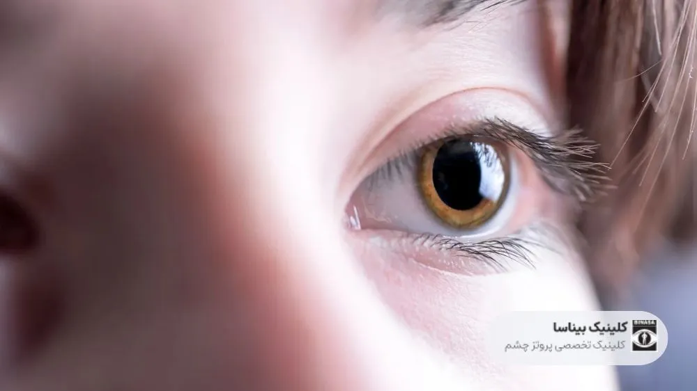 گشاد شدن مردمک چشم علت و عوارض