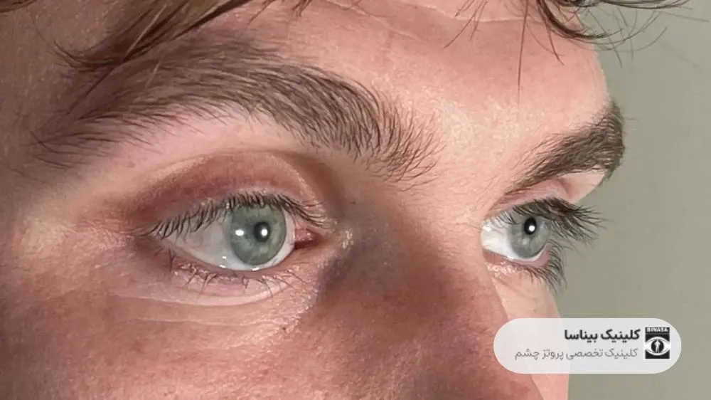 چشم مصنوعی برای کم بینایان