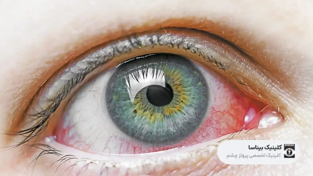 آمبولی چشم چیست؟