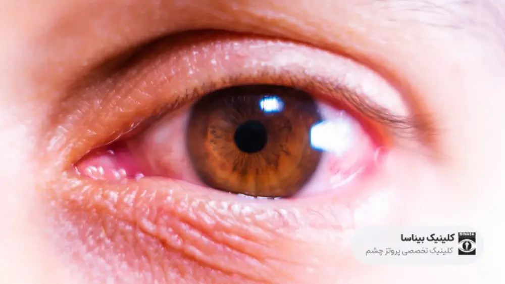 درمان آمبولی چشم