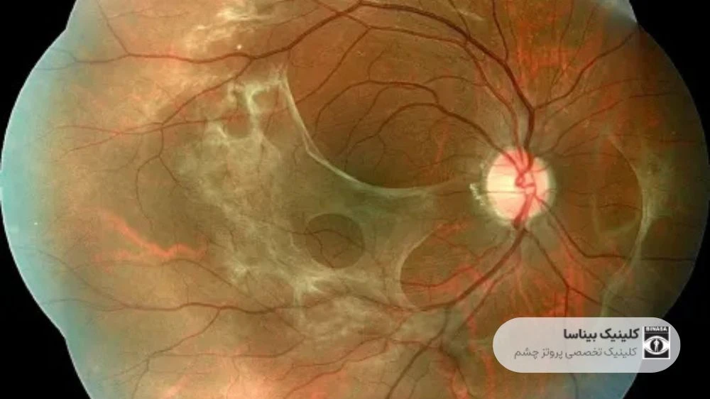 علت پارگی شبکیه چشم