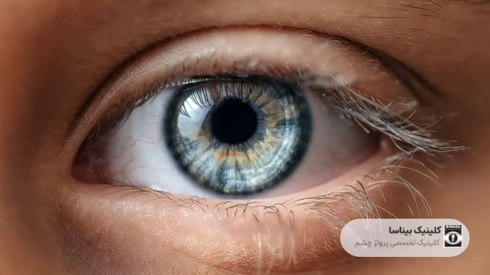 علت موج دار شدن دید چشم
