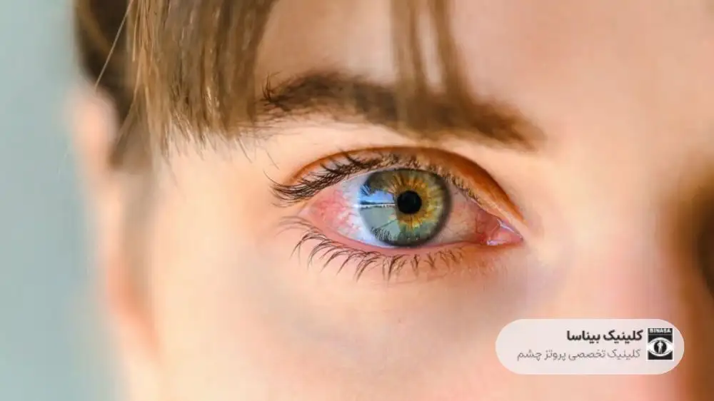آیا خشکی چشم می‌تواند منجر به نابینایی شود؟
