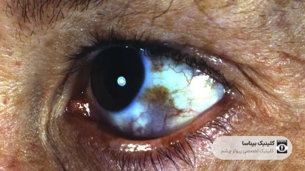 از کجا بفهمیم سرطان چشم داریم؟