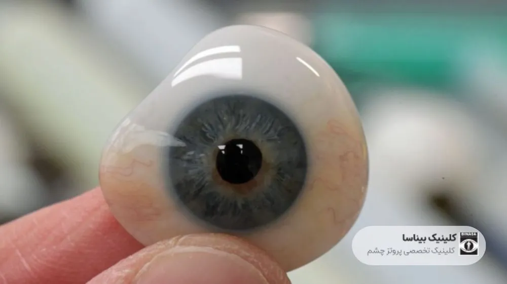 آیا پروتز متناسب با چشم دیگر حرکت می‌کند؟