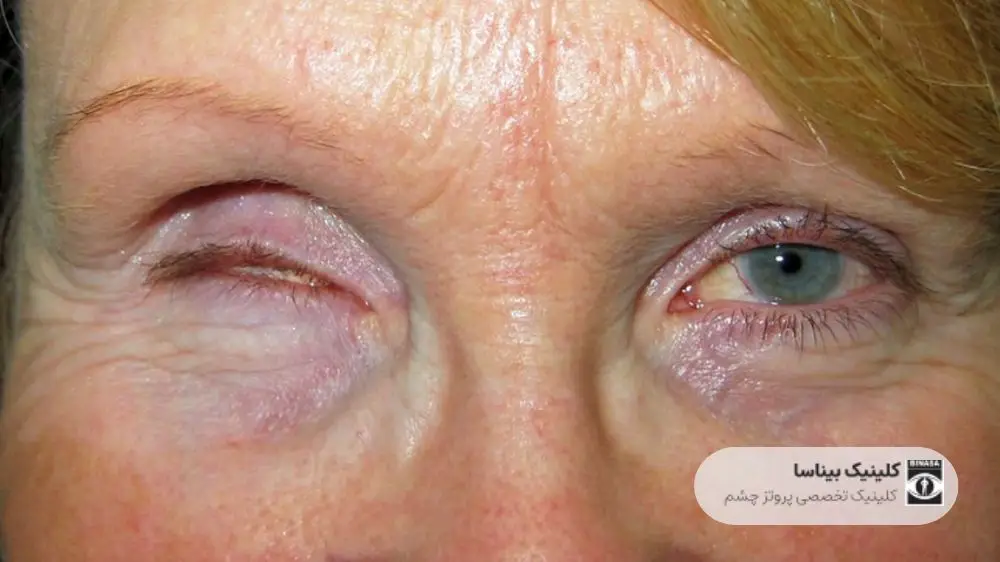 چه مشکلاتی می تواند مانع استفاده از پروتز چشم شود؟