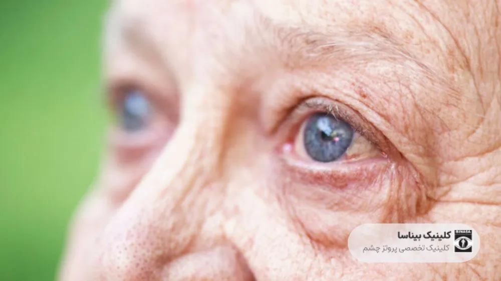 چشم مصنوعی در سالمندان