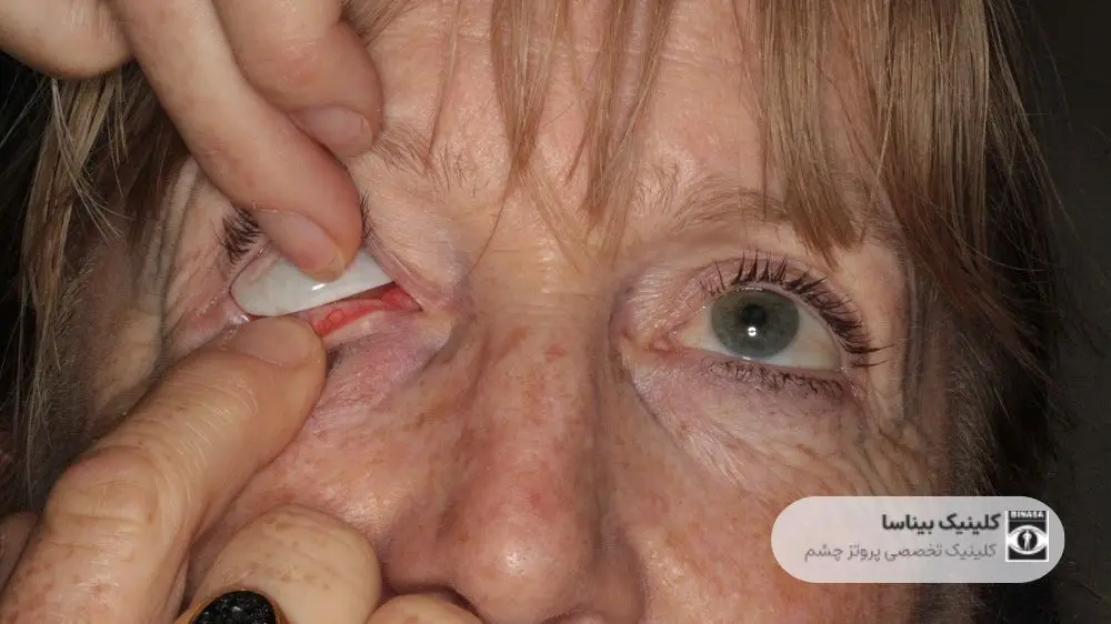 شرایط سنی استفاده از چشم مصنوعی