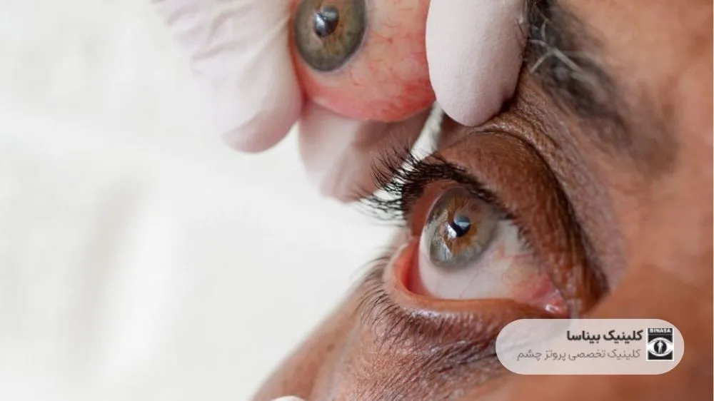 ویدیو آموزش برداشتن و گذاشتن پروتز چشم