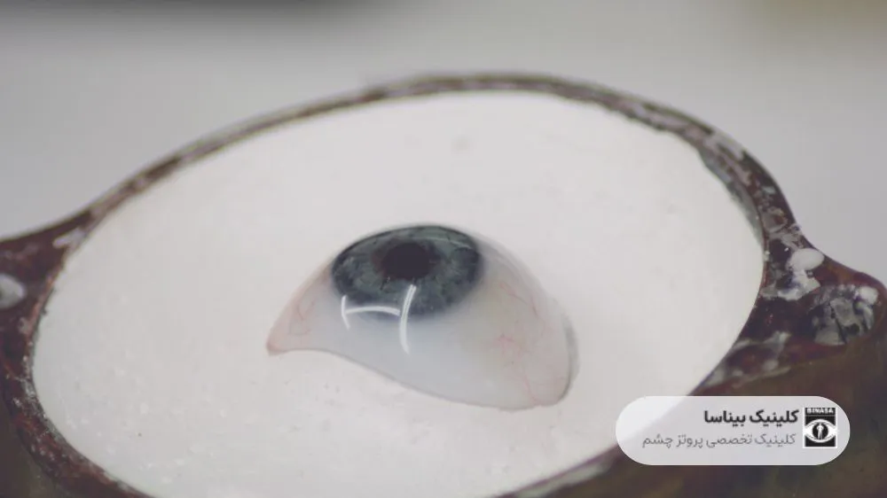 چگونه یک پروتز چشم با کیفیت انتخاب کنیم؟