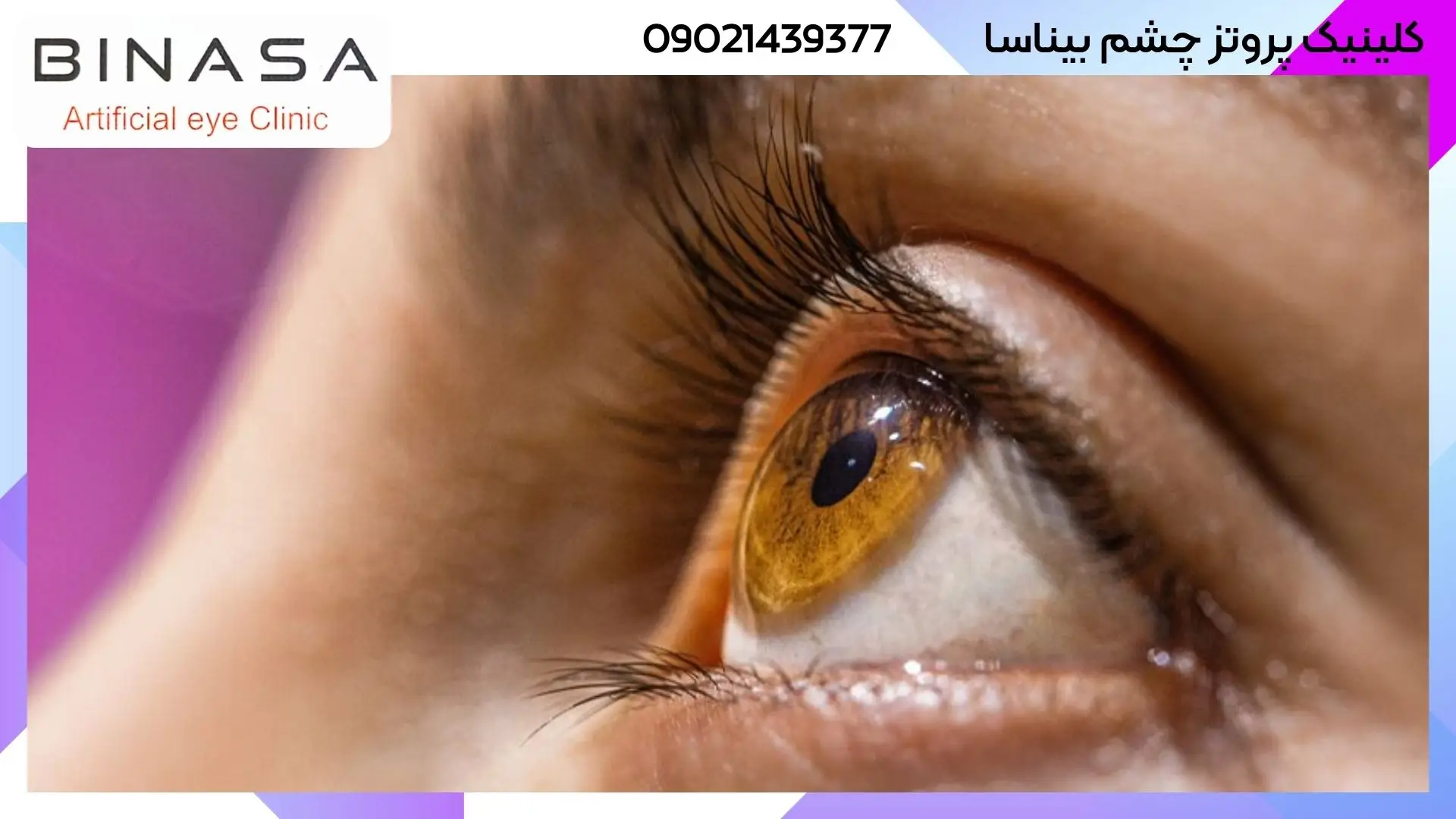 چه زمانی چشم نیاز به پروتز دارد؟